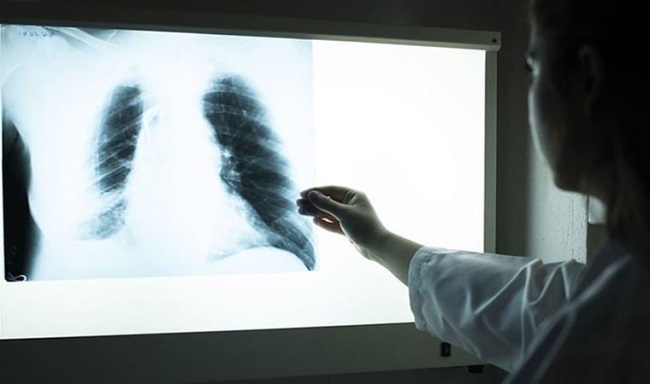 Akciğer kanserinde sigara ve hava krililiği başlıca riskler arasında